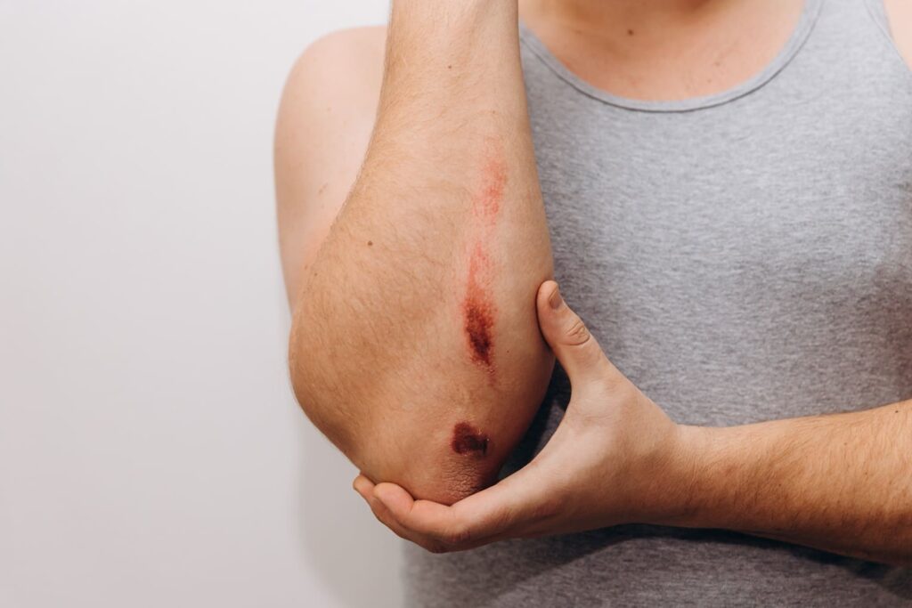 Abrasion wound on a man's elbow.